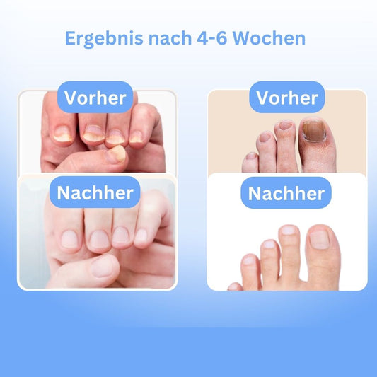 MykoCare - Innovative light treatment against nail fungus 1